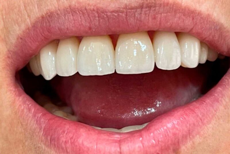 Tratamiento de conducto / Endodoncia en providencia